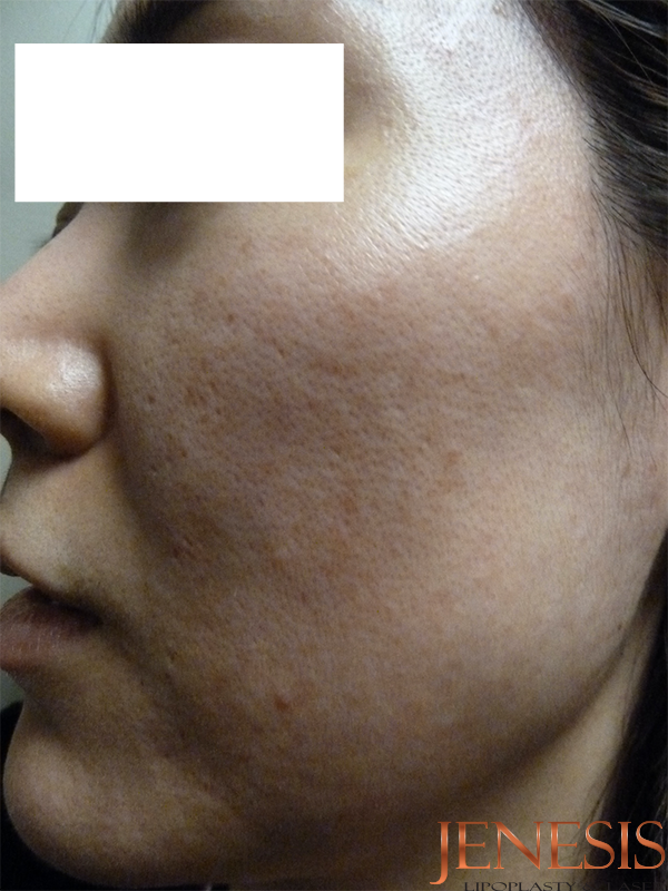 Co2 Laser Resurfacing