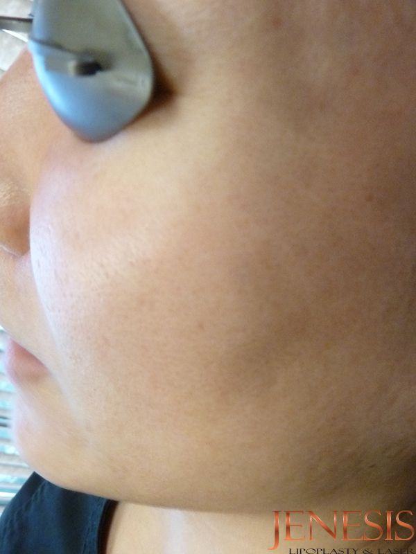 Co2 Laser Resurfacing
