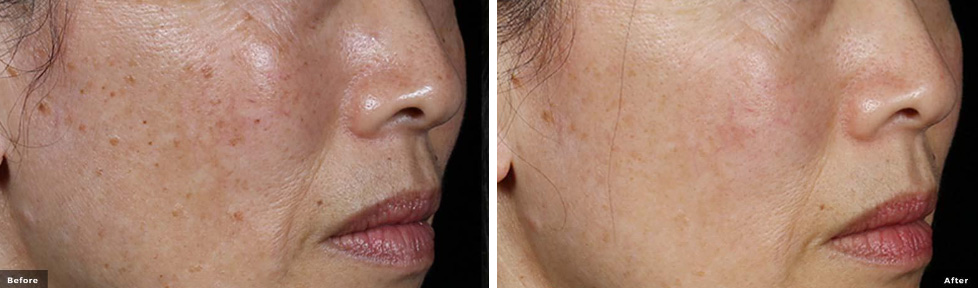 Pico enlighten® Before & After Results
