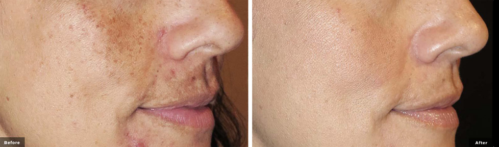 Pico enlighten® Before & After Results