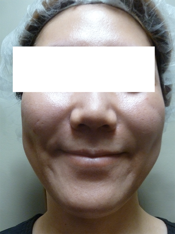 3D Lipo Face & Neck