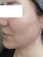 3D Lipo Face & Neck