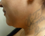 3D Lipo Face & Neck