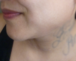 3D Lipo Face & Neck