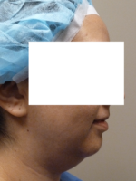 3D Lipo Face & Neck