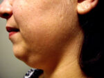 3D Lipo Face & Neck