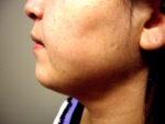 3D Lipo Face & Neck