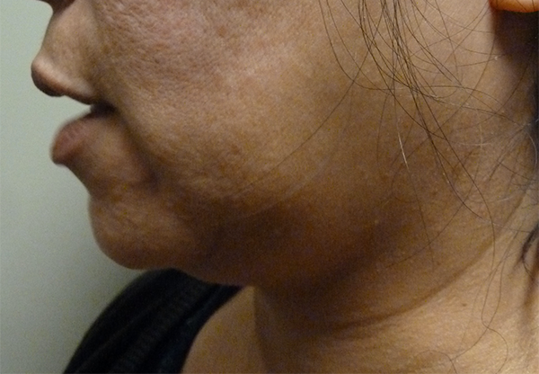 3D Lipo Face & Neck