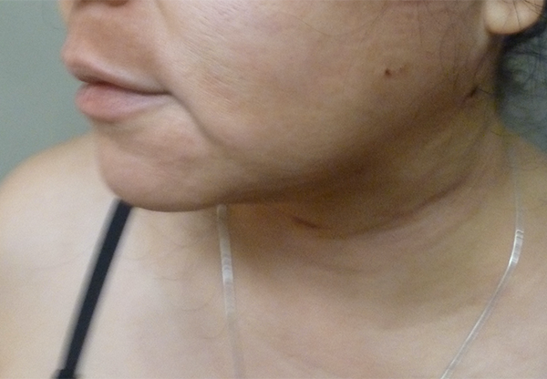 3D Lipo Face & Neck