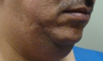 3D Lipo Face & Neck