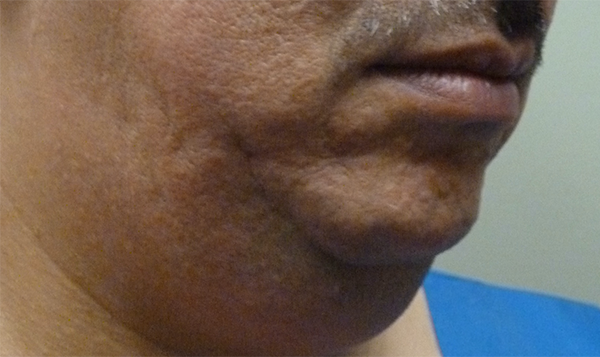 3D Lipo Face & Neck