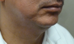 3D Lipo Face & Neck