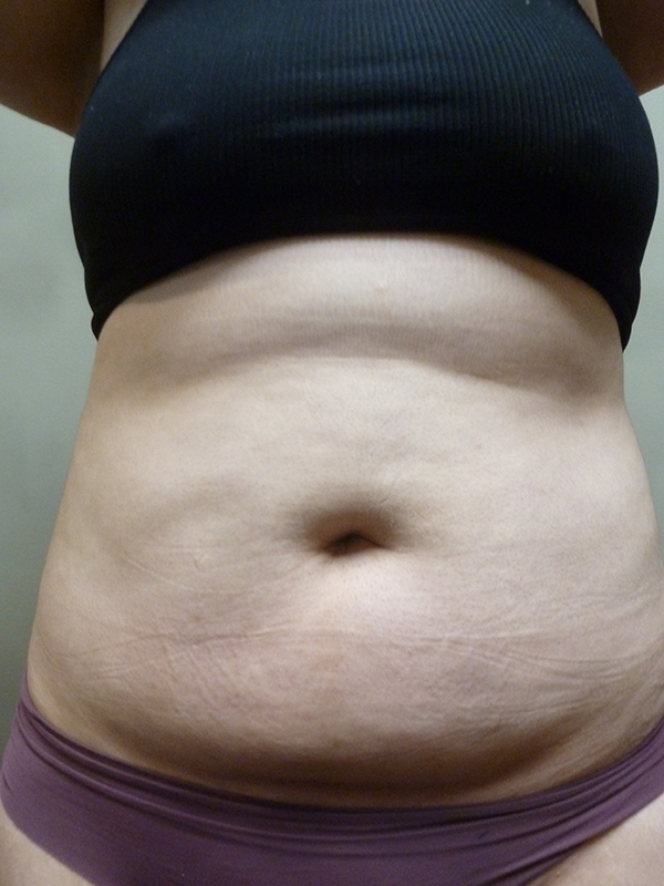 3D Lipo Female