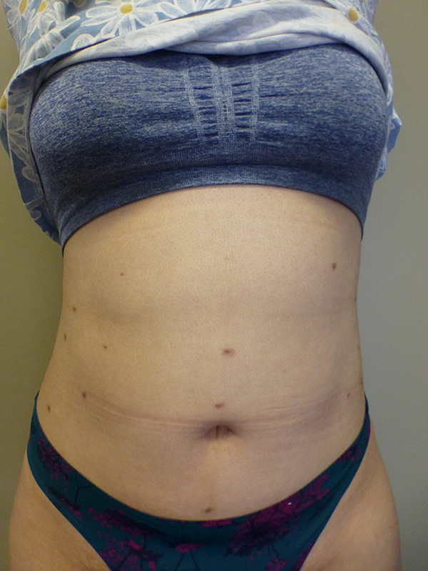 3D Lipo Female