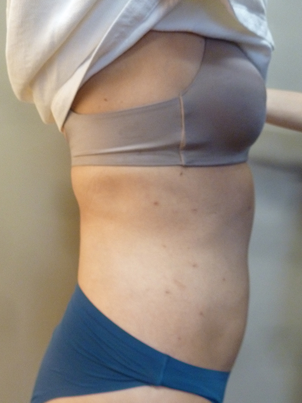 3D Lipo Female