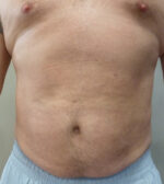 3D Lipo Male