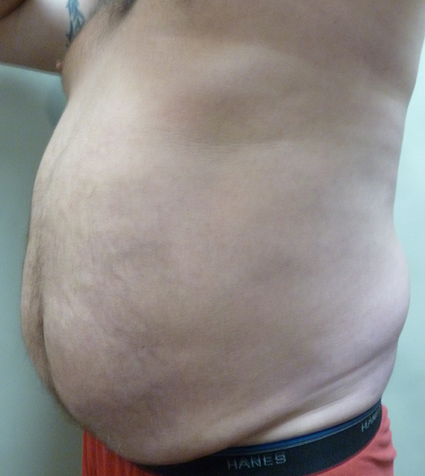 3D Lipo Male