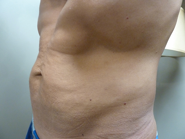 3D Lipo Male