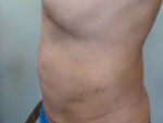 3D Lipo Male