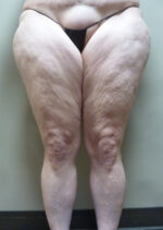 3D Lipo Legs