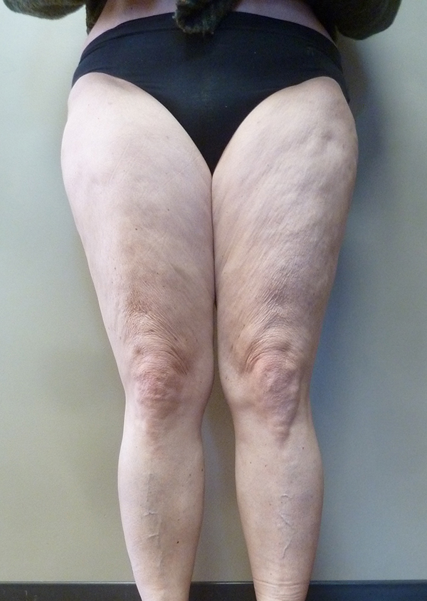 3D Lipo Legs