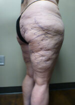 3D Lipo Legs