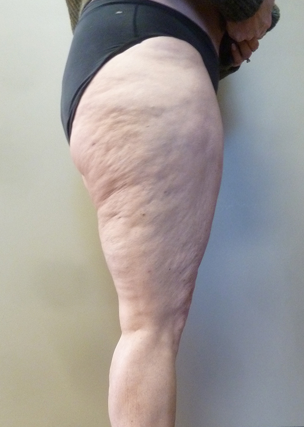 3D Lipo Legs