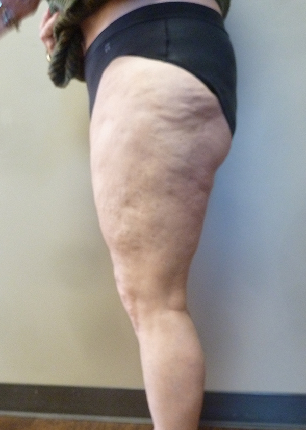 3D Lipo Legs