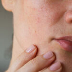 Acne scars on the skin of the face