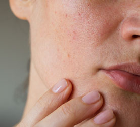 Acne scars on the skin of the face