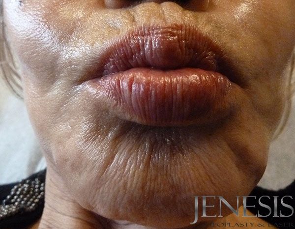 2 Juvederm Lyft