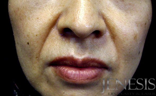 2 Juvederm Lyft