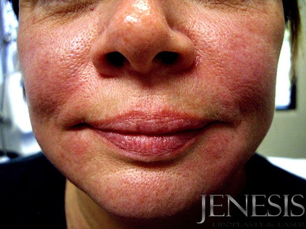 2 Juvederm Lyft