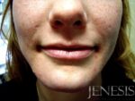 2 Juvederm Lyft