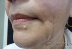 2 Juvederm Lyft