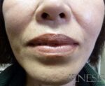 2 Juvederm Lyft