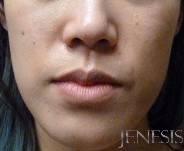 2 Juvederm Lyft