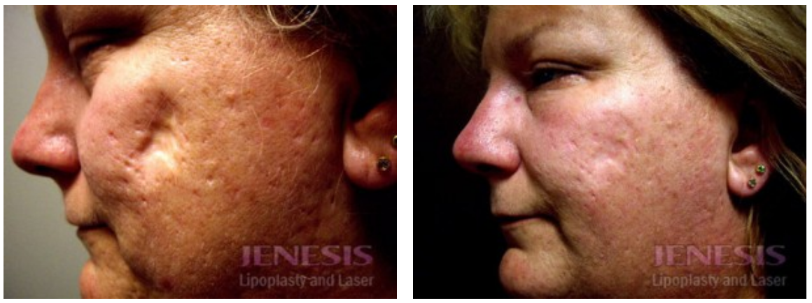 Fractional Co2 Acne Scar Treatment Before & After Results