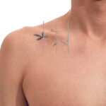 Laser tattoo removal procedure