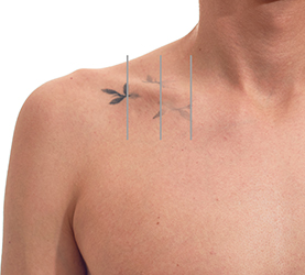 Laser tattoo removal procedure
