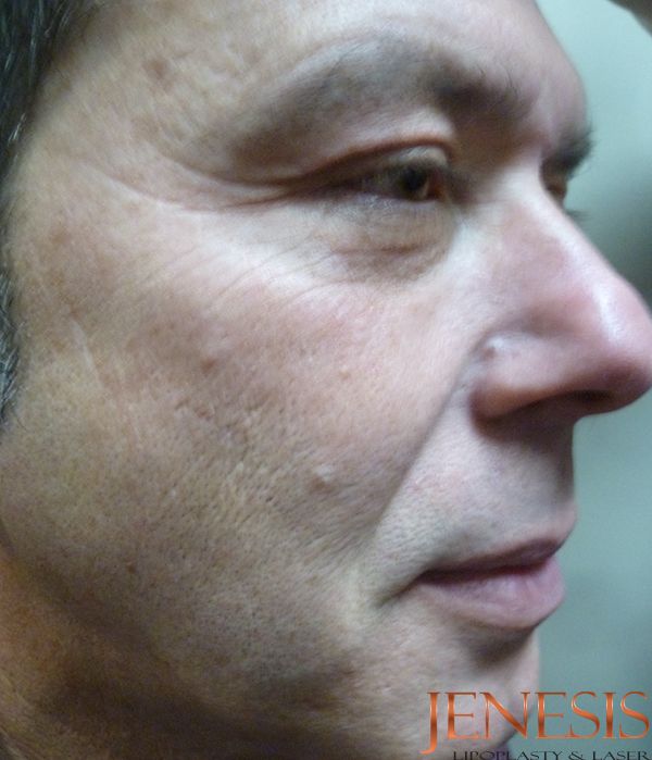 Co2 Laser Resurfacing