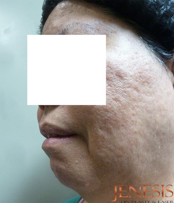 Ultherapy