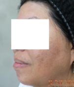 Ultherapy