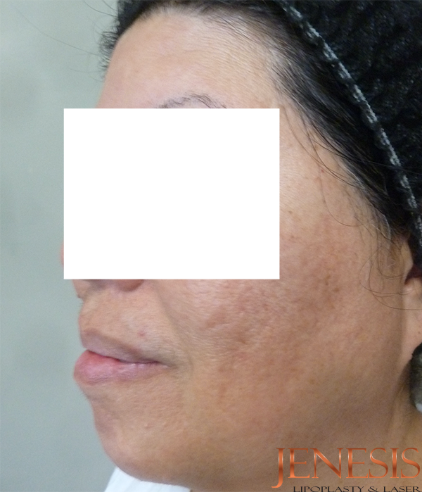 Ultherapy