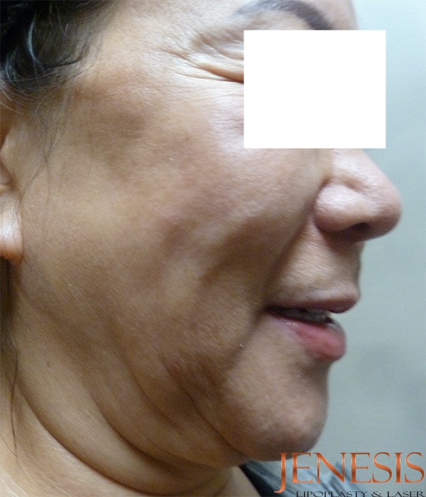 Ultherapy