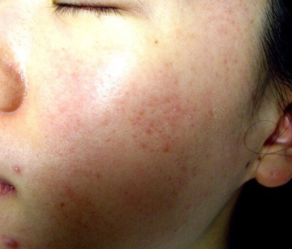 Acne Agnes RF
