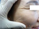 Skin Booster Filler