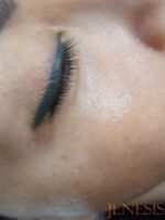 Skin Booster Filler