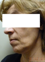 Ultherapy