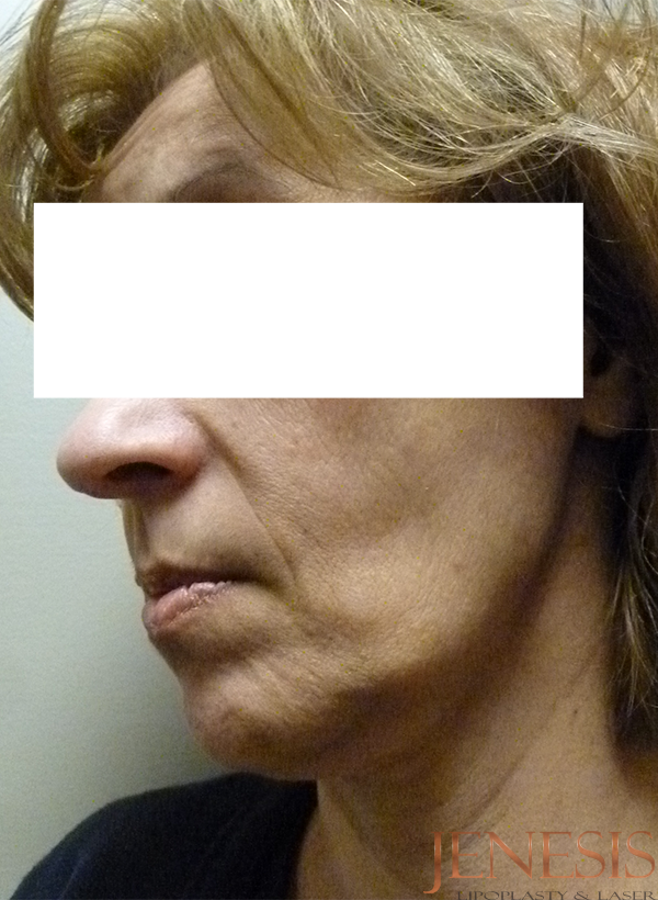 Ultherapy